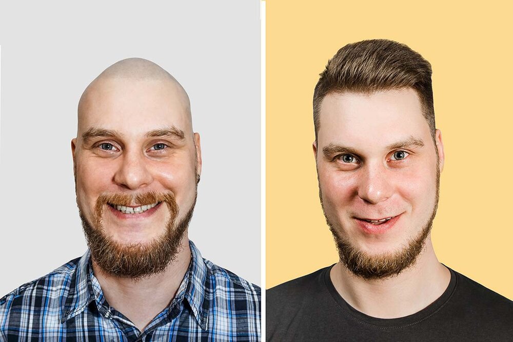Hair-Transplant-Toronto-01.jpg Hair-Transplant-Toronto-01.jpg