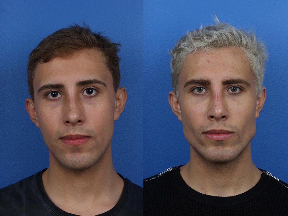 jaw-augmentation.jpg jaw-augmentation.jpg