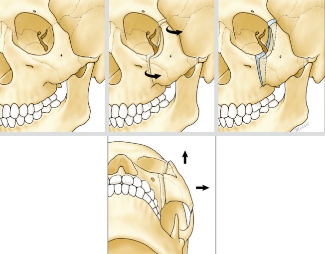 Tripod-osteotomy-Schema-of-orbital-expansion-by-tripod-osteotomy.jpg Tripod-osteotomy-Schema-of-orbital-expansion-by-tripod-osteotomy.jpg